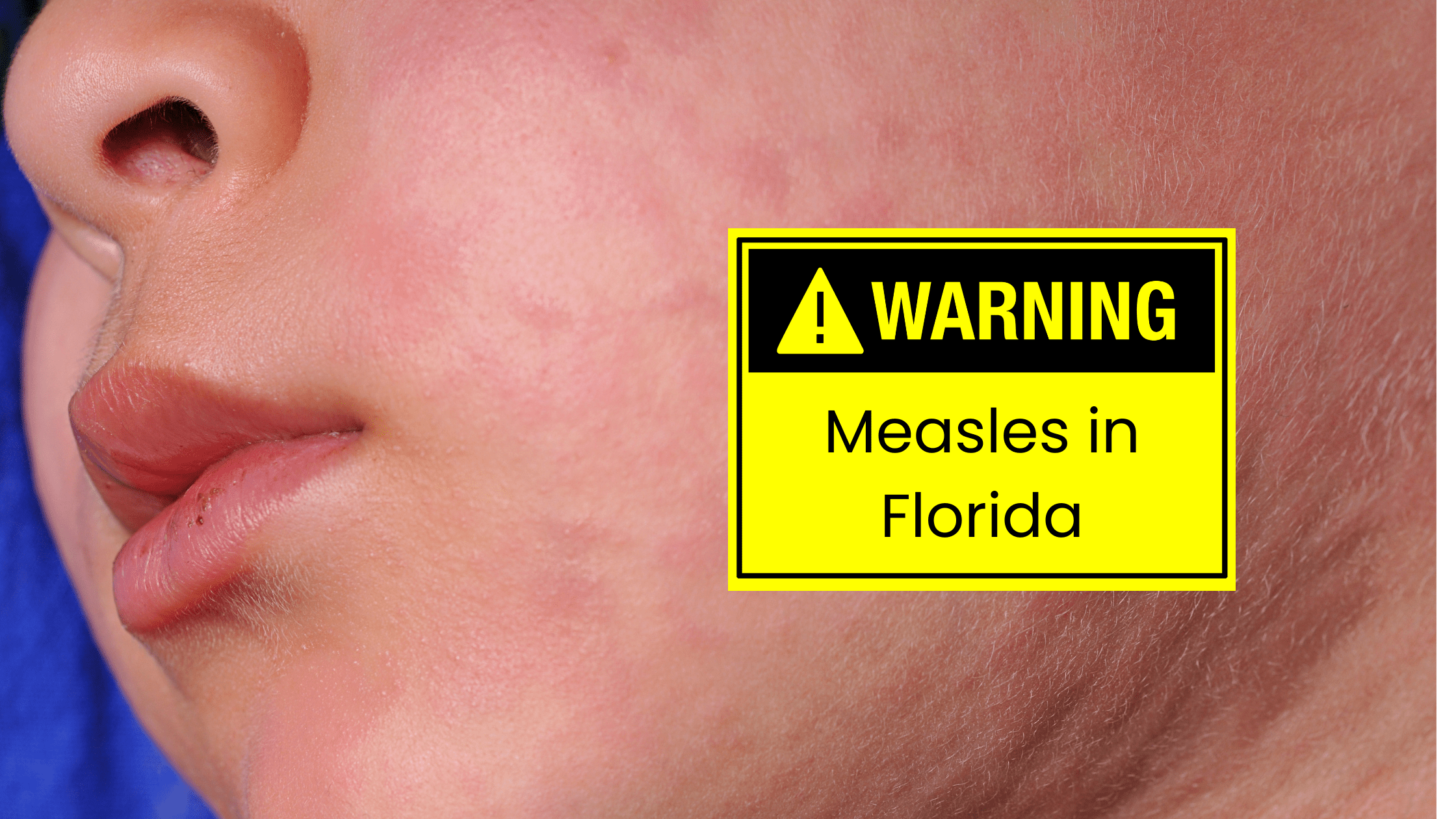 Measles Outbreak Reaches Florida